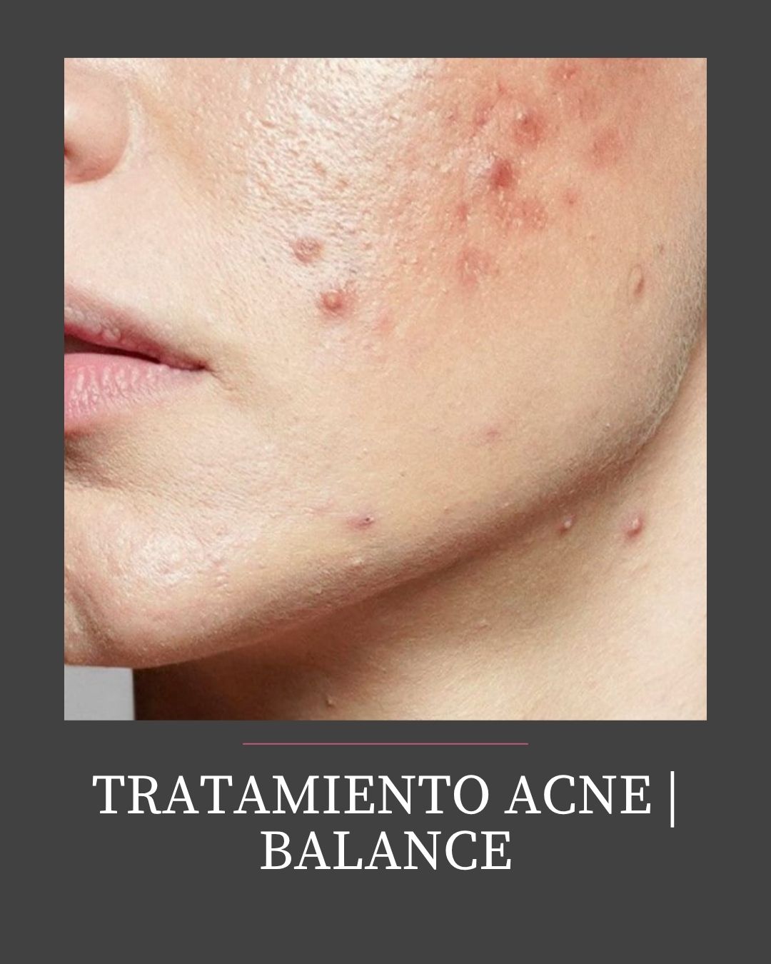 TRATAMIENTO ACNÉ