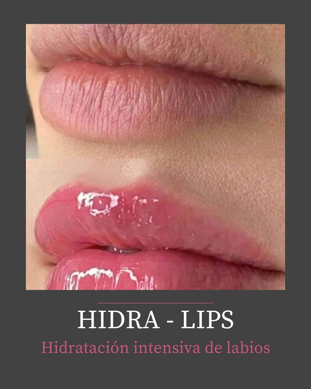 HIDRA - LIPS