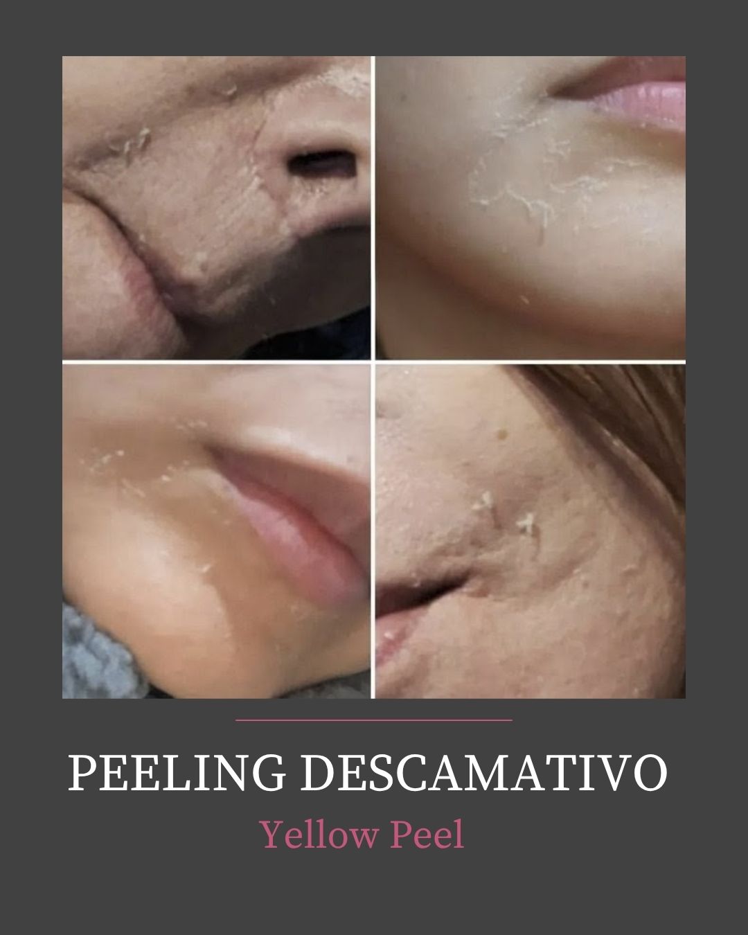 PEELING DESCAMATIVO