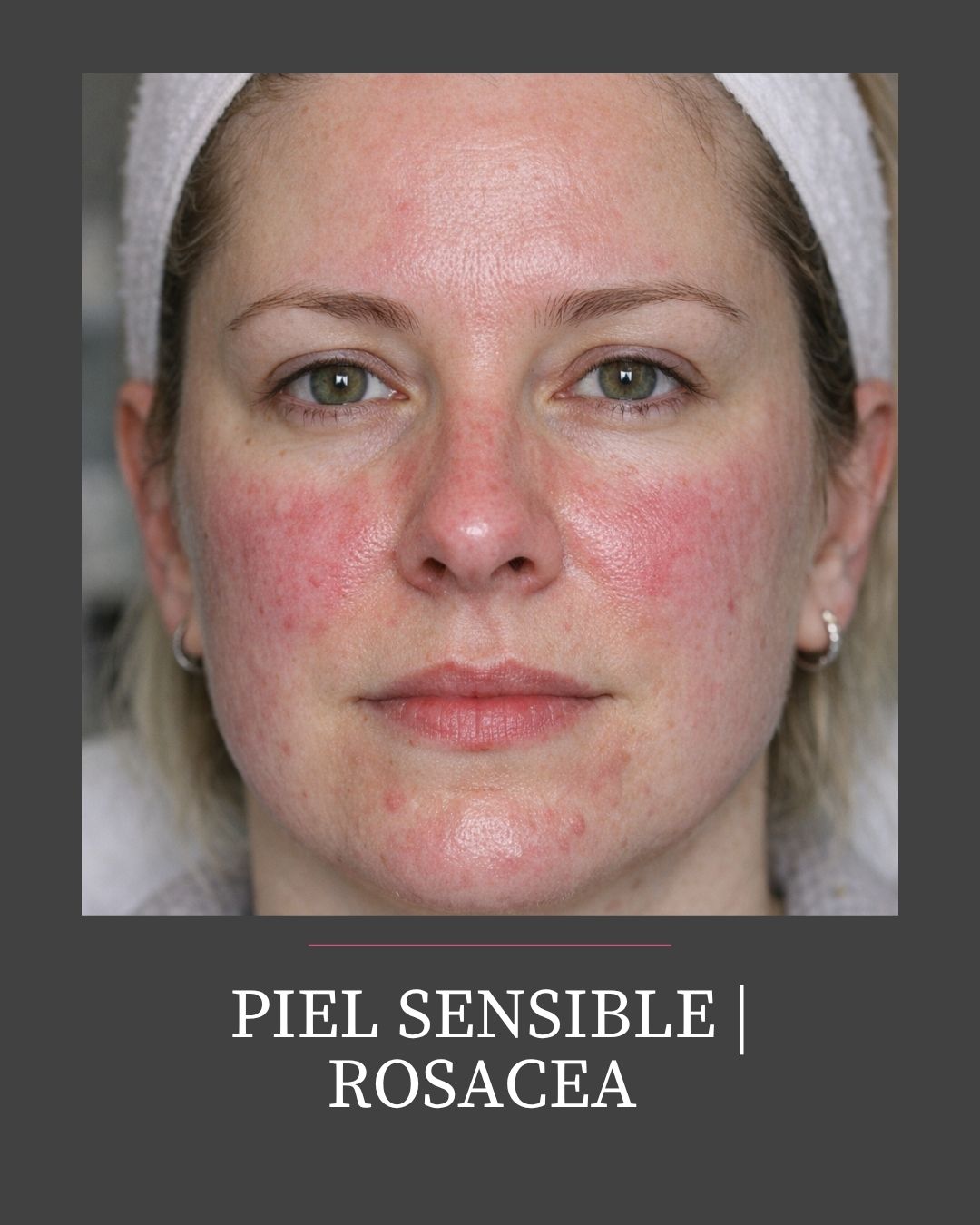PIEL SENSIBLE | ROSÁCEA
